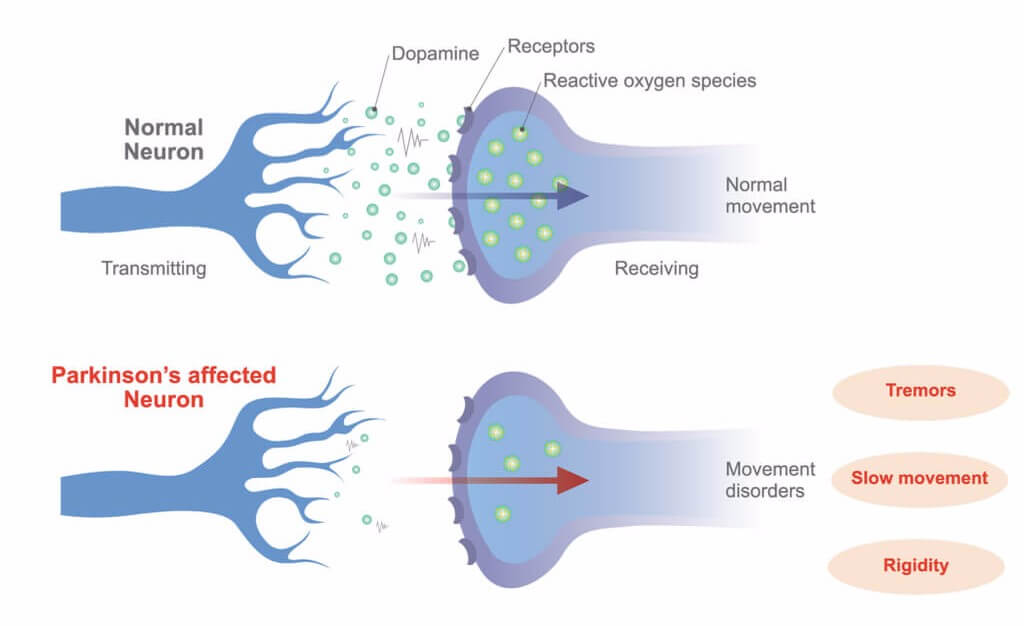 Two Proteins In The Brain Could Protect Against And Repair The Damage Cause...