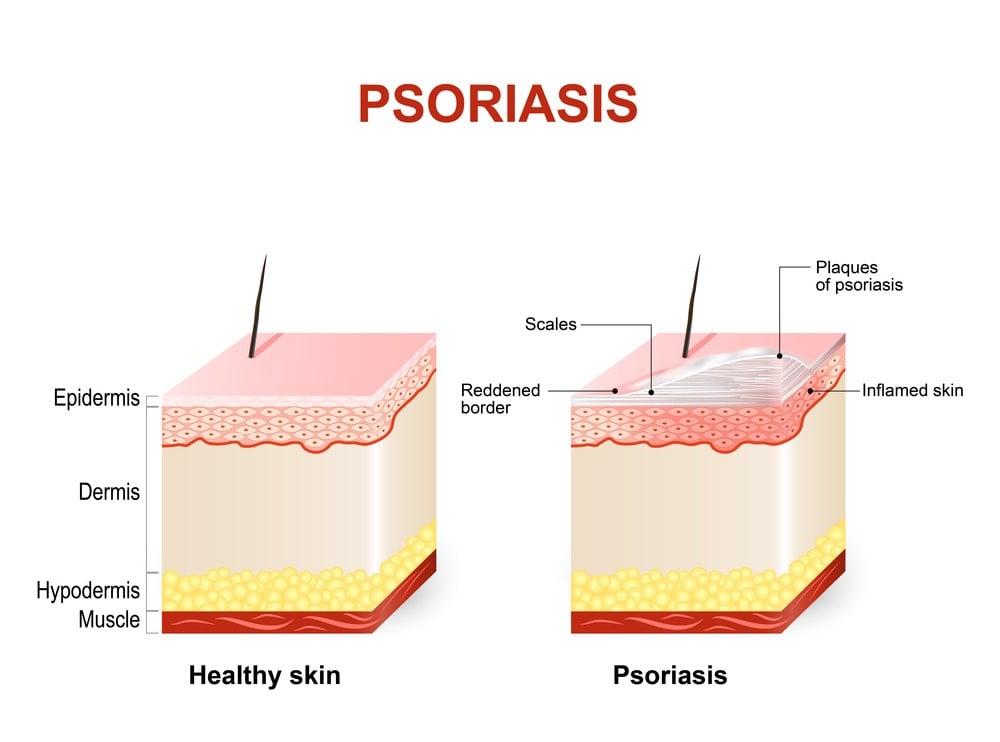 Psoriasis: Lőrincz, Kende - sutemenyrecept.hu