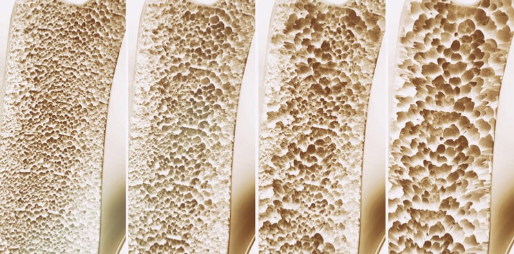 Osteogenesis imperfecta Mereo EMA