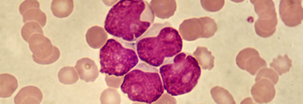 acute myeloid leukemia