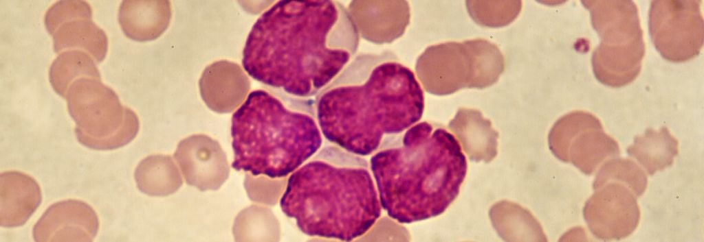 acute myeloid leukemia