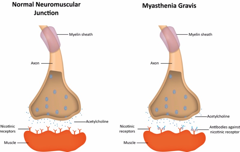 myasthenia gravis treatment argenx