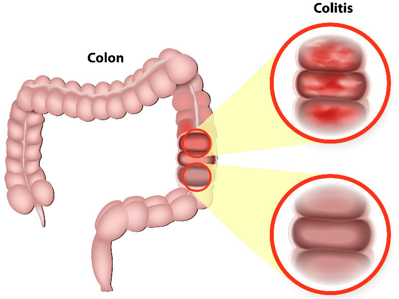 German DNA Treatment Reduces Ulcerative Colitis Symptoms