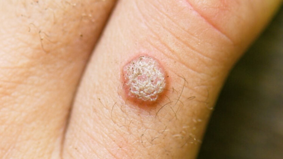 Hpv infection symptoms causes mayo clinic 46 off
