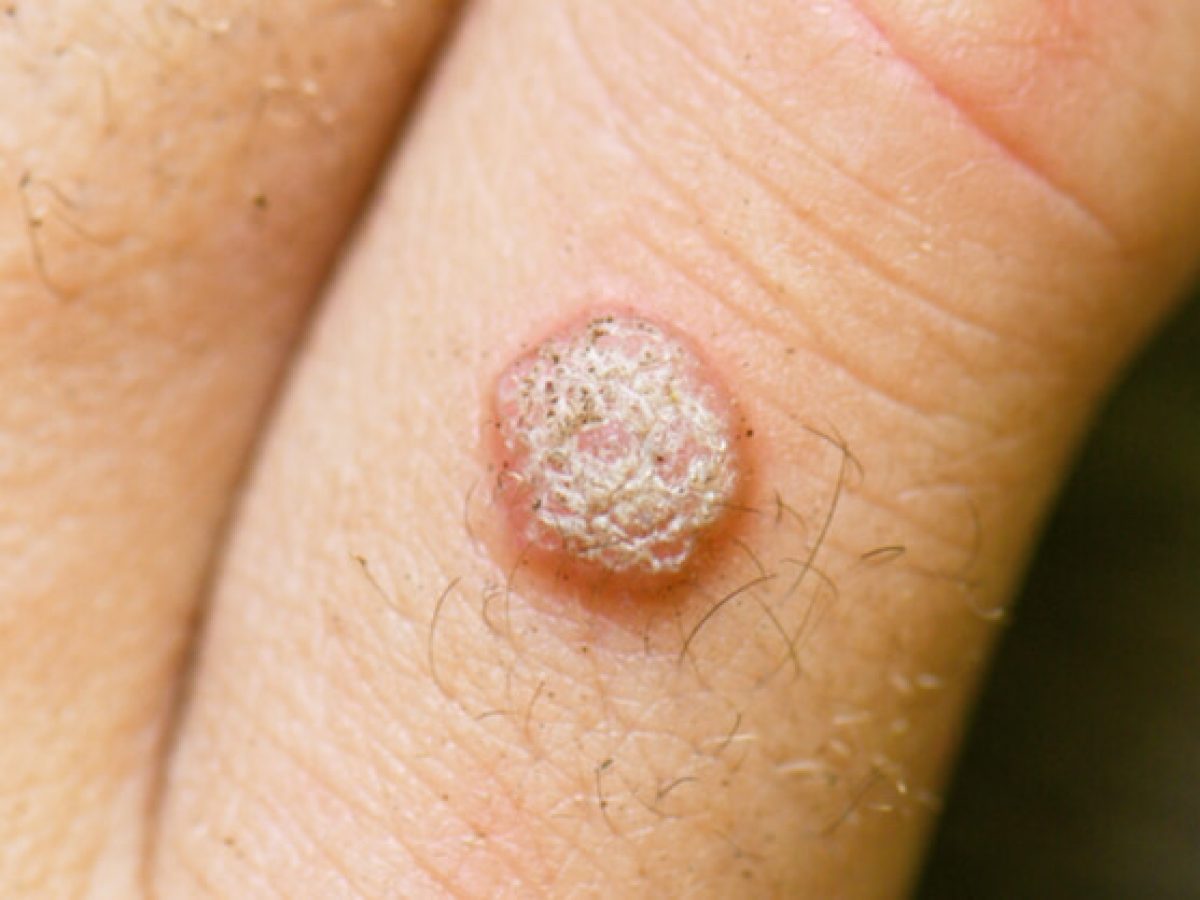 papilloma and wart