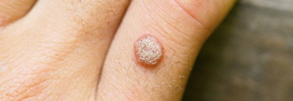 papillomavirus warts