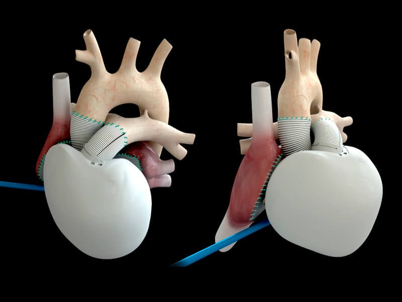 artificial-heart-failure-carmat