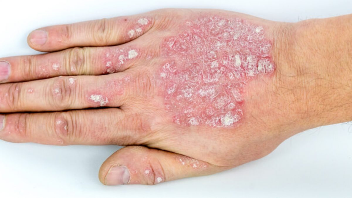 psoriasis trials uk