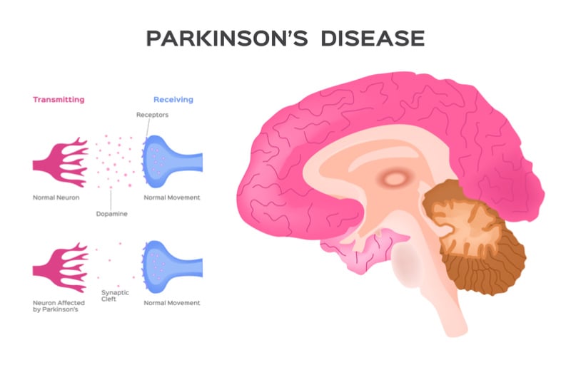 Leading AI Company Supports UK Charities in Fighting Parkinson's Disease