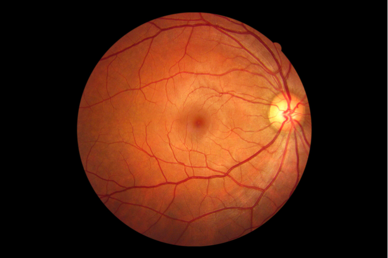 Oxford Spin-out moves Gene-therapy for Blindness into Phase III Trial