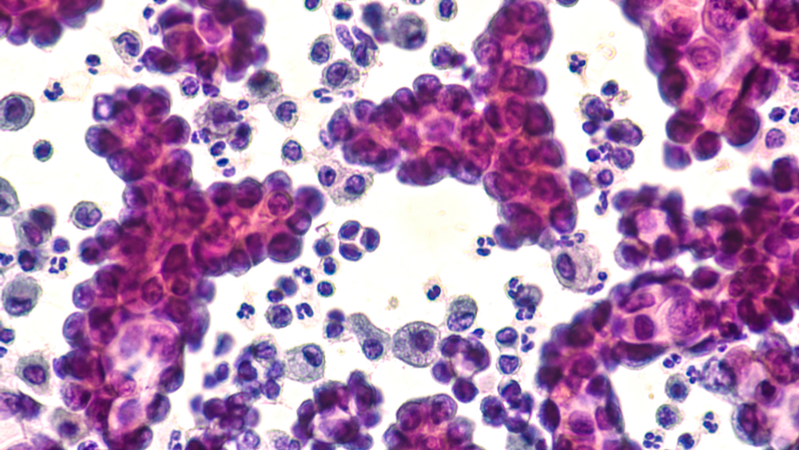 French Biotech Resumes Halted Lung Cancer Trial After 8 Months