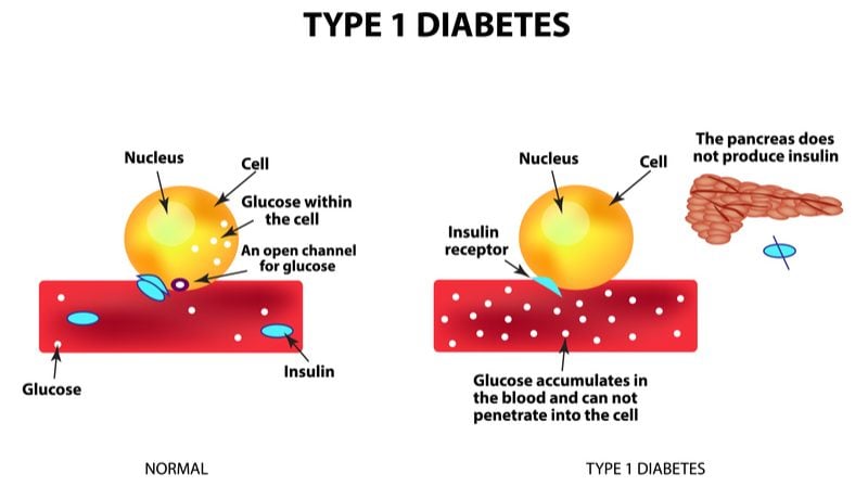 can type 1 diabetes be reversed)