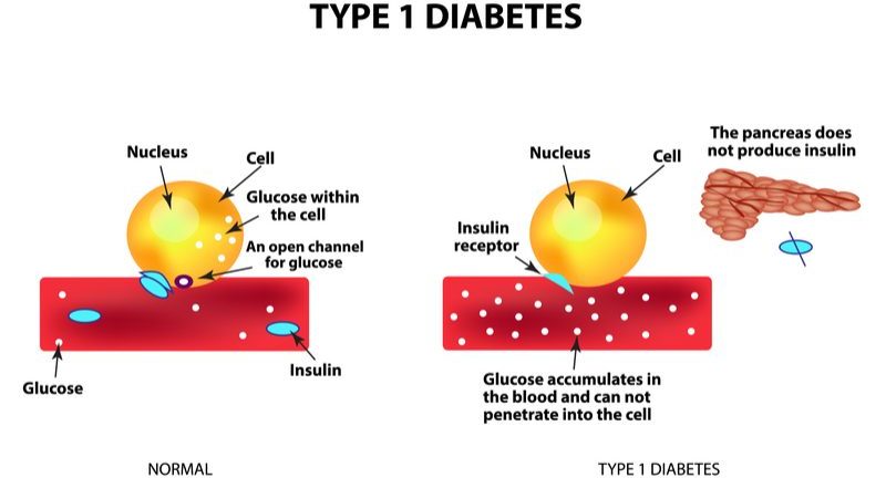 Adocia's Double-Hormone Diabetes Treatment is Set to Enter Phase I Trial