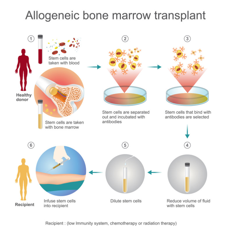 Series B Funding Helps Dutch Biotech Fight Graft Versus Host Disease