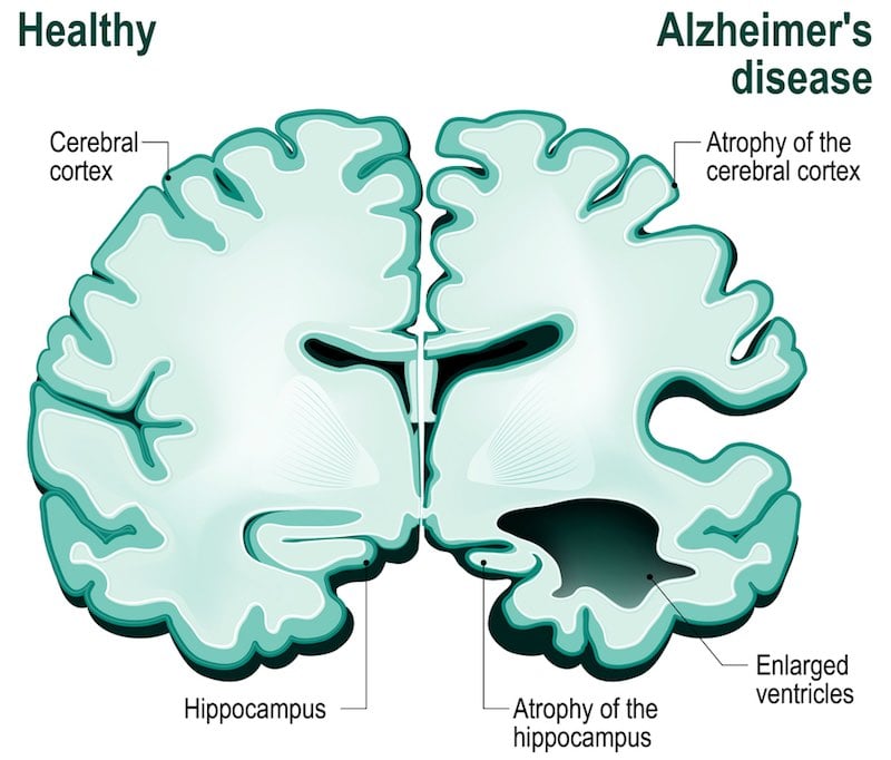 alzheimers-disease clinical-trials