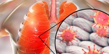 Irish Pneumonia Antibiotic Gets Positive Phase III Results