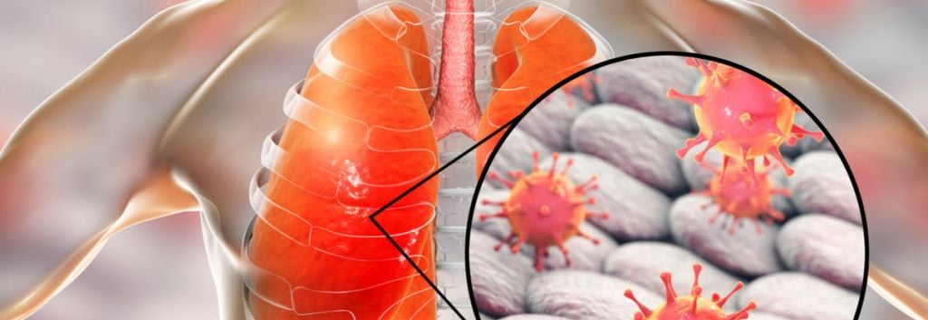 Nabriva Therapeutics Pneumonia Antibiotic