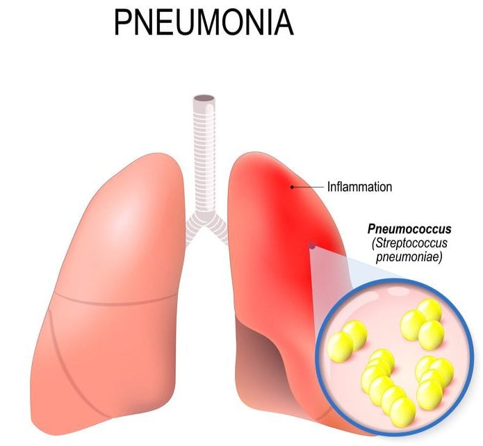 Irish Pneumonia Antibiotic Gets Positive Phase III Results 