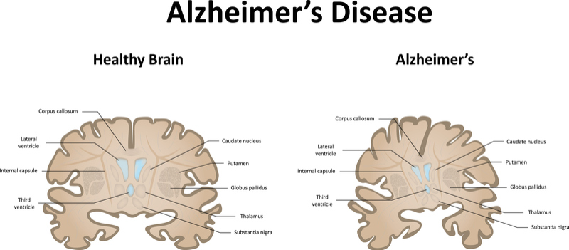 Swedish Alzheimer’s Treatment Slows the Disease in Phase II Trial