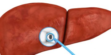 French Biotech Raises €40M to Fight Hepatitis and NASH