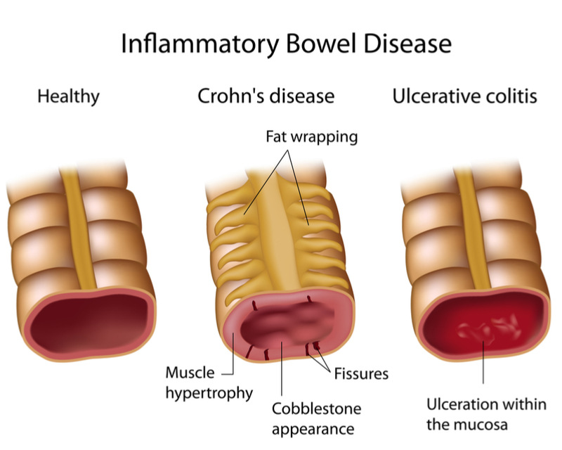 Microbiotica Enters $534M Deal To Develop Microbiome Treatments for IBD