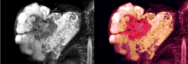 Soft tissue sarcoma