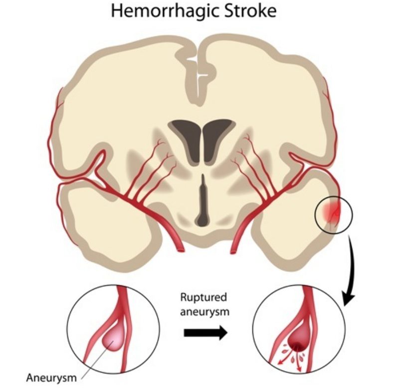 Swiss Biotech Tackles Brain Artery Constriction Caused by Hemorrhage