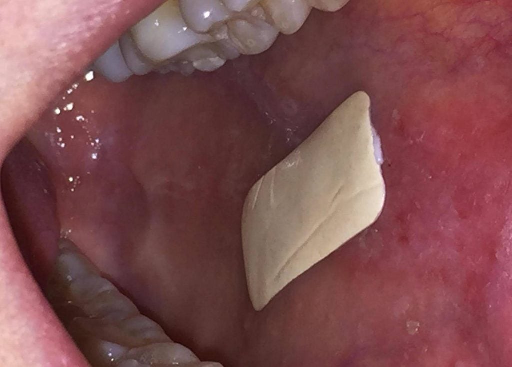 A Biodegradable Plaster Could Help us Treat Mouth Ulcer Patients