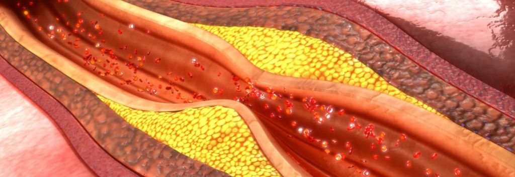 pluristem cell therapy peripheral artery disease