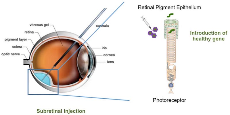 Horama retinitis pigmentosa gene therapy