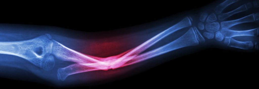 bone Therapeutics cell therapy bone fracture