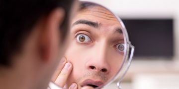 Cassiopoeia acne panic