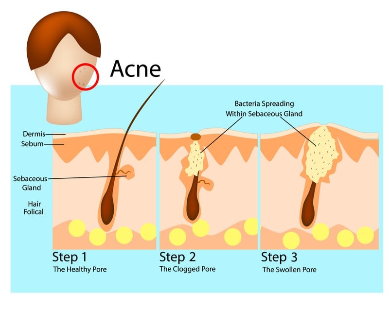 cassiopoeia acne diagram 