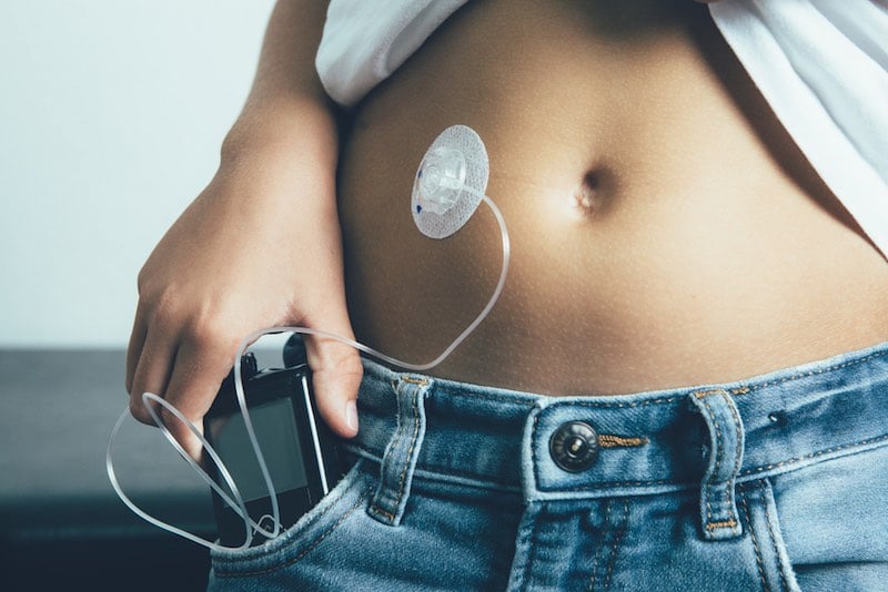 artificial pancreas type 1 diabetes insulin pump blood sugar