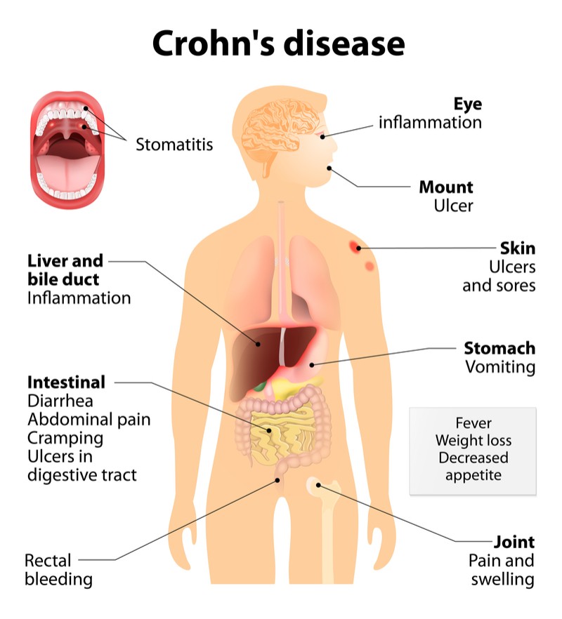 enterome microbiome crohns disease