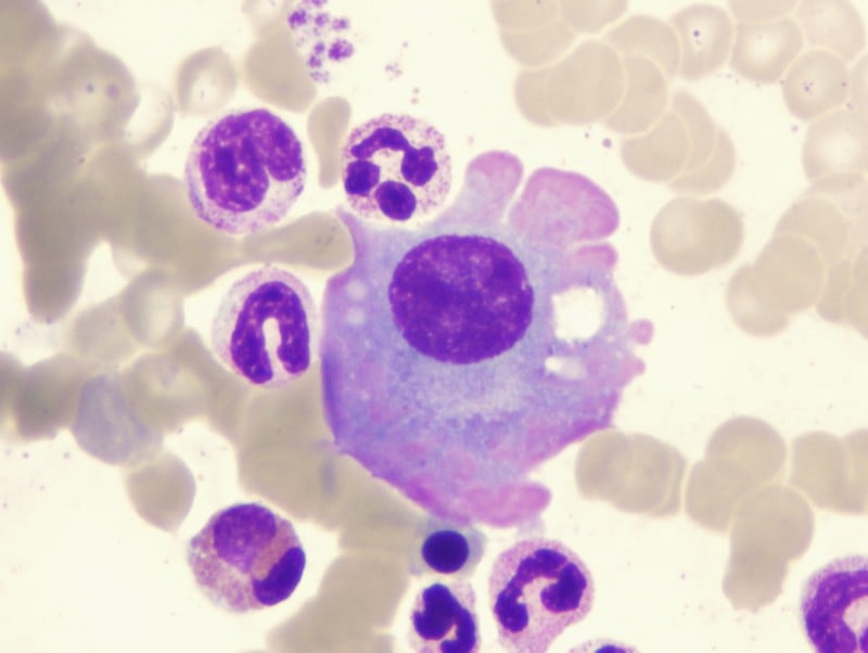 genmab multiple myeloma plasma cell