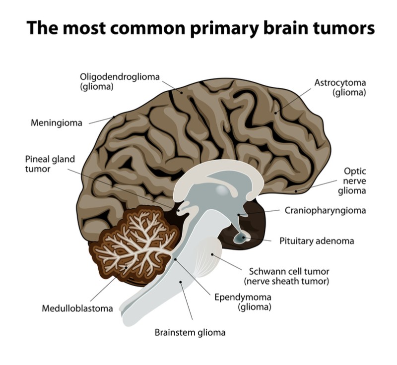 BOTW pro-actina brain cancer glioma common