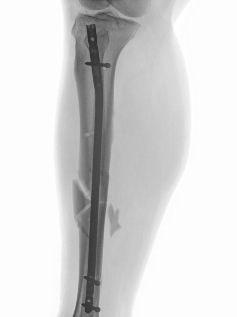 Synoste Bone lengthening intramedullary nail