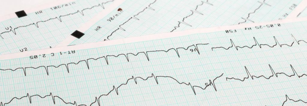 omeicos heart arrhythmia