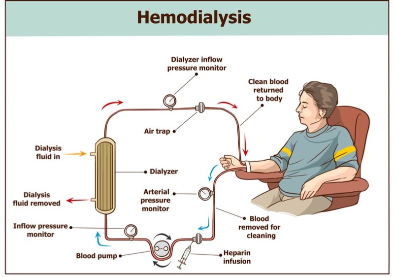 optofluid technologies kidney dialysis diagram