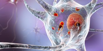 united neuroscience Parkinson's disease