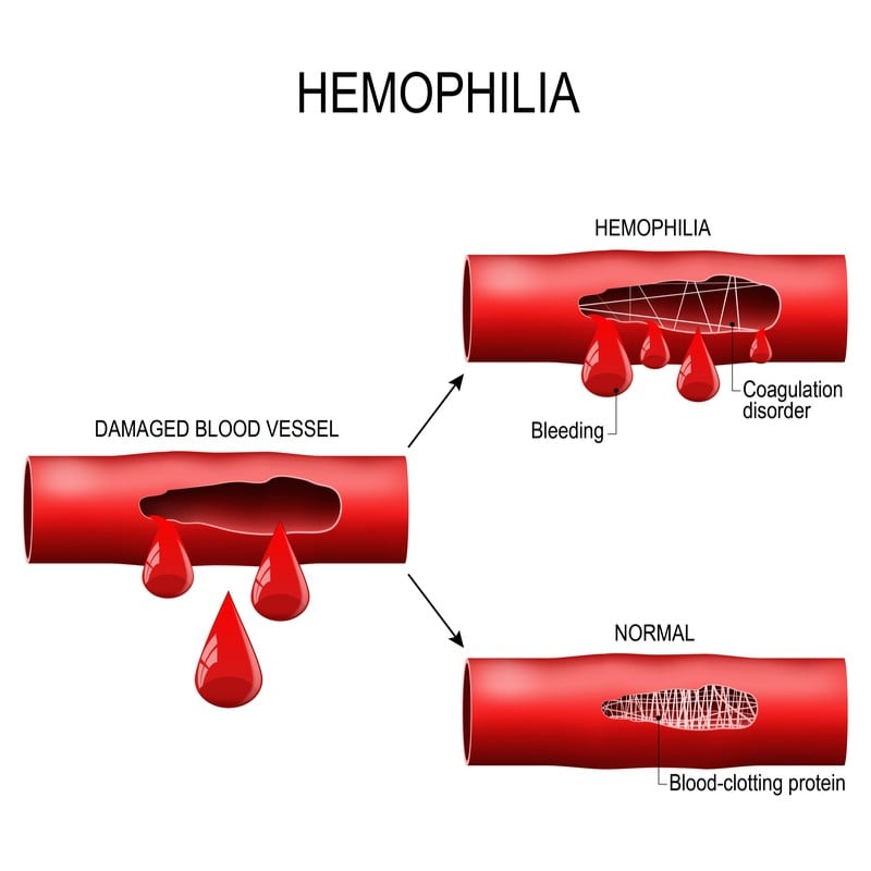 uniQure Freeline aruvant blood disorders hemophilia diagram