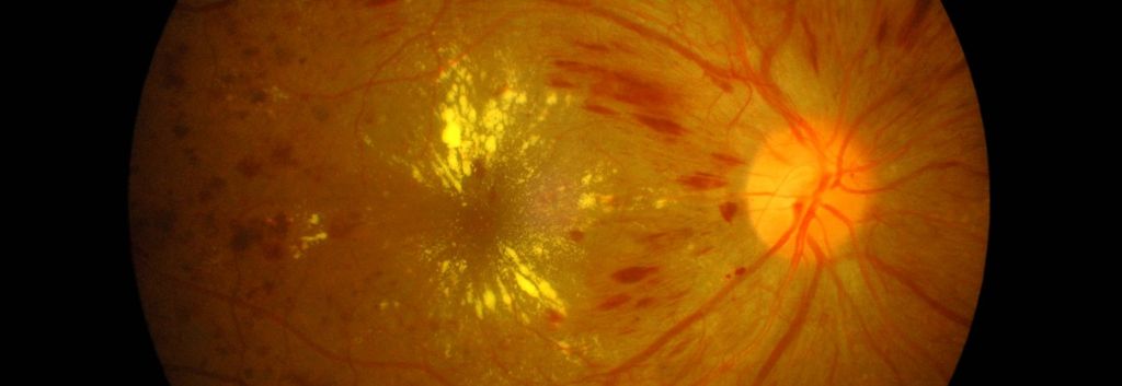 Oculis header diabetic macular edema