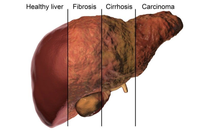 liver cirrhosis treatment versantis