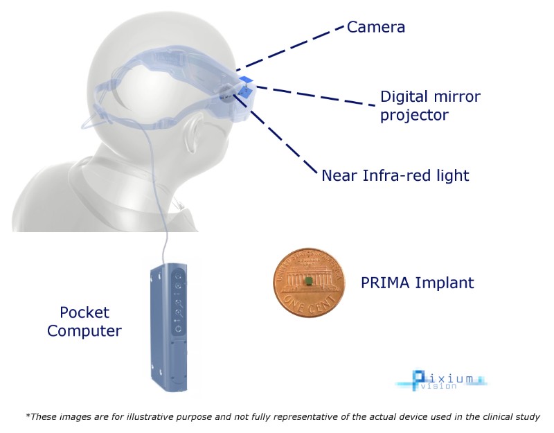 pixium vision retinal implant dry age-related macular degeneration Prima