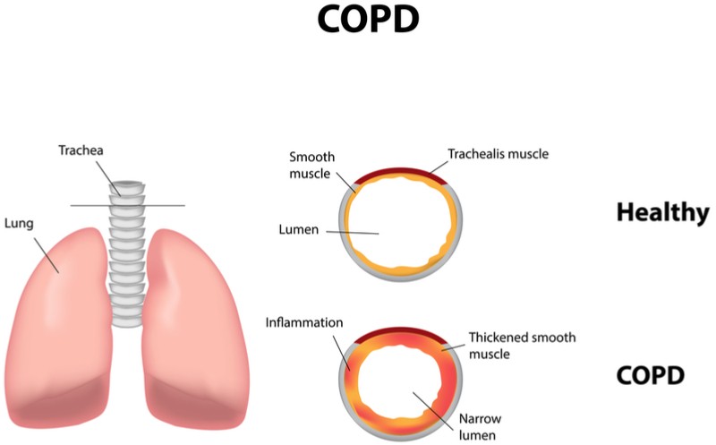 verona pharma lung disease copd