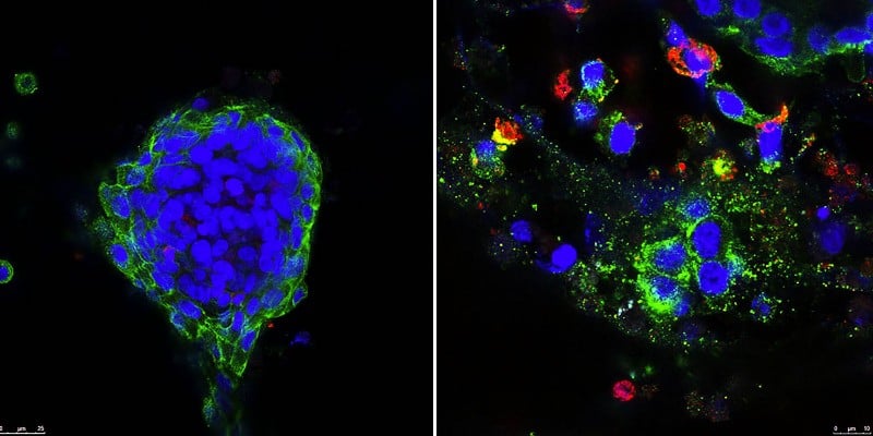 breast cancer metformin klefstrom university of helsinki checkpoint inhibitor