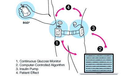 Artificial pancreas diabetes