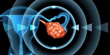 Sotio ovarian cancer immunotherapy
