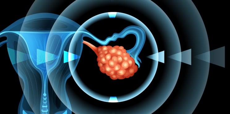 Sotio ovarian cancer immunotherapy